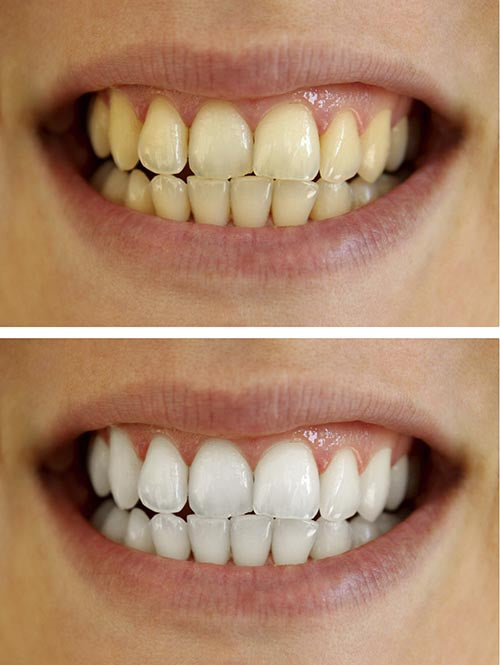 Crest D White Smile Kit