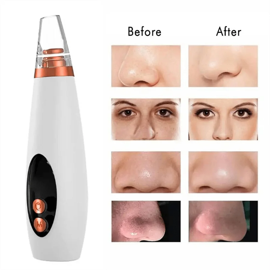 Handy Pore Electric Blackhead Remover Margot Vital